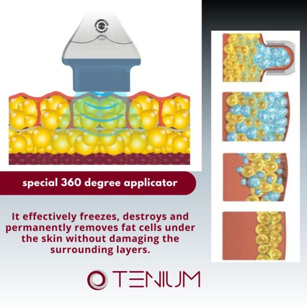 Cryolipolysis Cryo360 JL3000 PROKH - for weight loss and body contouring
