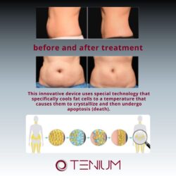 258 Cryolipolysis Cryo360 JL18 – for weight loss and body contouring