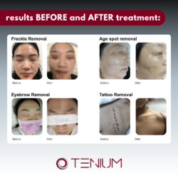 133 Portable Picosecond Laser SH9 Mini – for tattoo removal, pigmentation spots, and skin rejuvenation