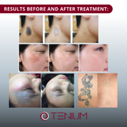 147 Picosecond laser SH750 - for skin rejuvenation, tattoo and pigment spot removal