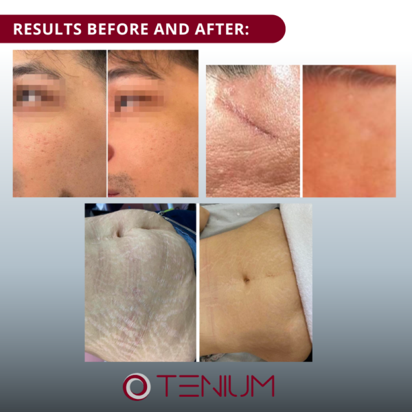 156 Portable radiofrequency mesotherapy machine up to 4mm SH10 mini - for tightening, lifting and treatment of the face and body