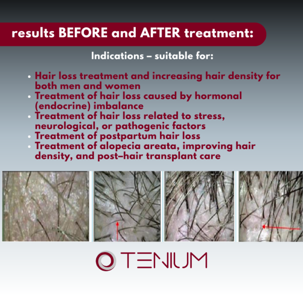 171 Diode laser SH13 with LED therapy for reducing hair loss and promoting hair growth