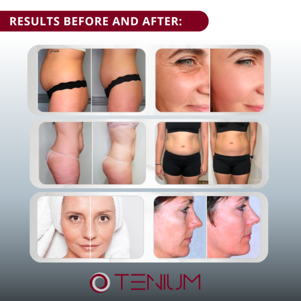 INDEEPRO SH3000 - for body contouring, shaping and facial rejuvenation