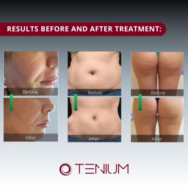 230 Wave Slim JLS PRO - for weight loss and body contouring