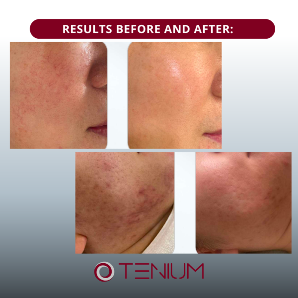 73 SDPL SH15 Machine – for Skin Treatments, Photorejuvenation, Pigmentation, Acne, Rosacea, and Hair Removal